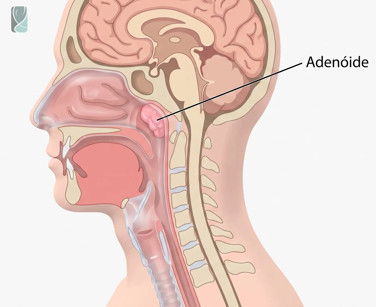 Ilustração da adenoide aumentada, localizada atrás da cavidade nasal