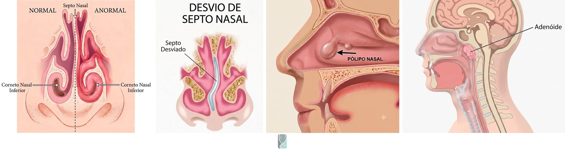 Ilustração dos fatores obstrutivos nasais que podem causar o ronco: aumento das conchas nasais, desvio de septo, pólipo nasal e aumento da adenoide