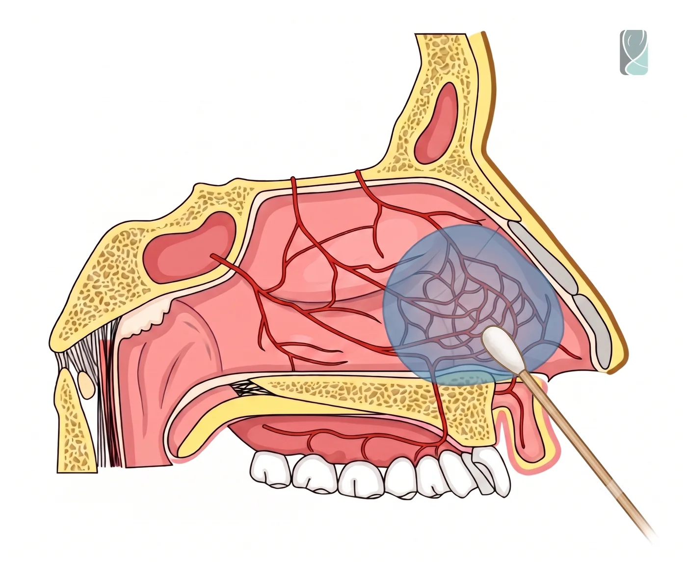 Ilustração da cauterização nasal realizada em consultório