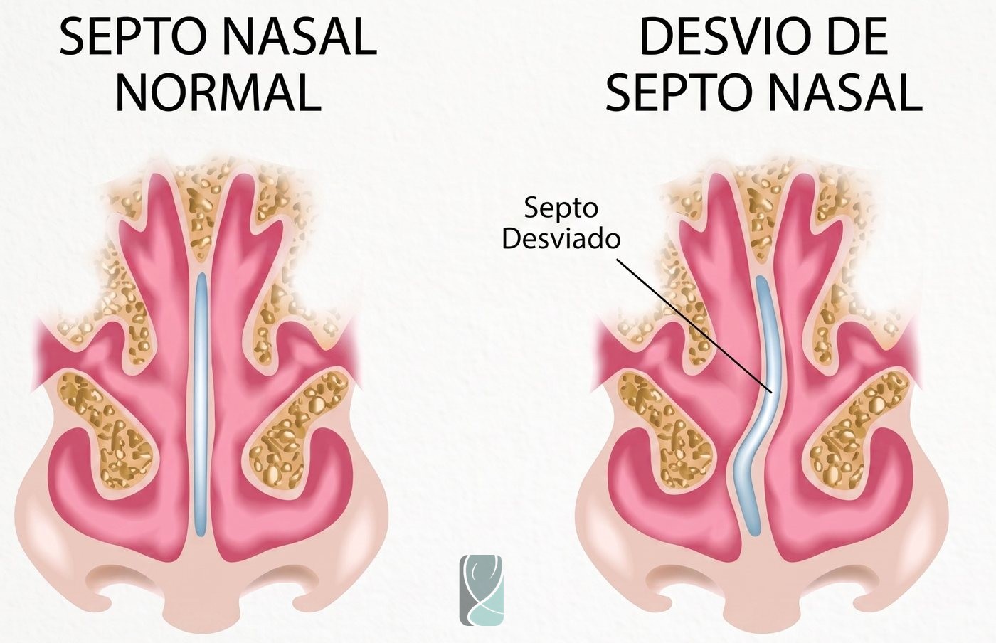 Desvio do Septo Nasal