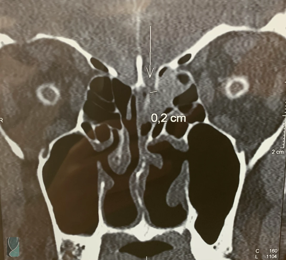 Cisternotomografia mostrando uma abertura de 0,2 cm na base do crânio, na região olfatória, compatível com fístula liquórica