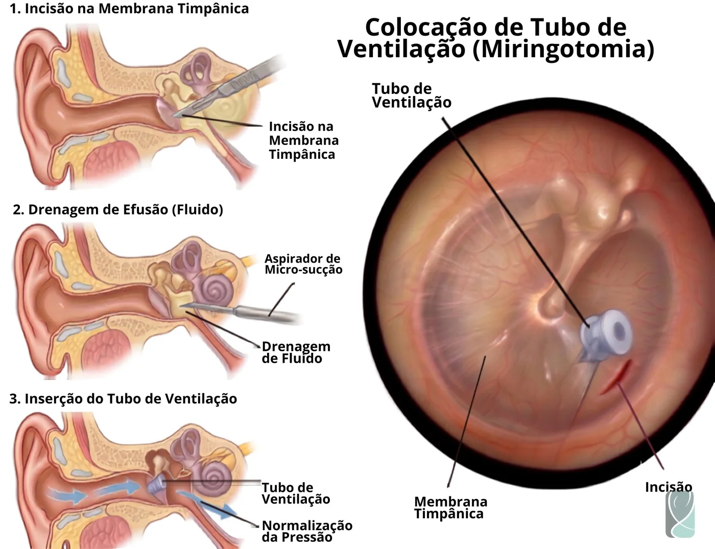 Ilustração dos passos da miringotomia: incisão na membrana timpânica, drenagem da efusão e inserção do tubo de ventilação