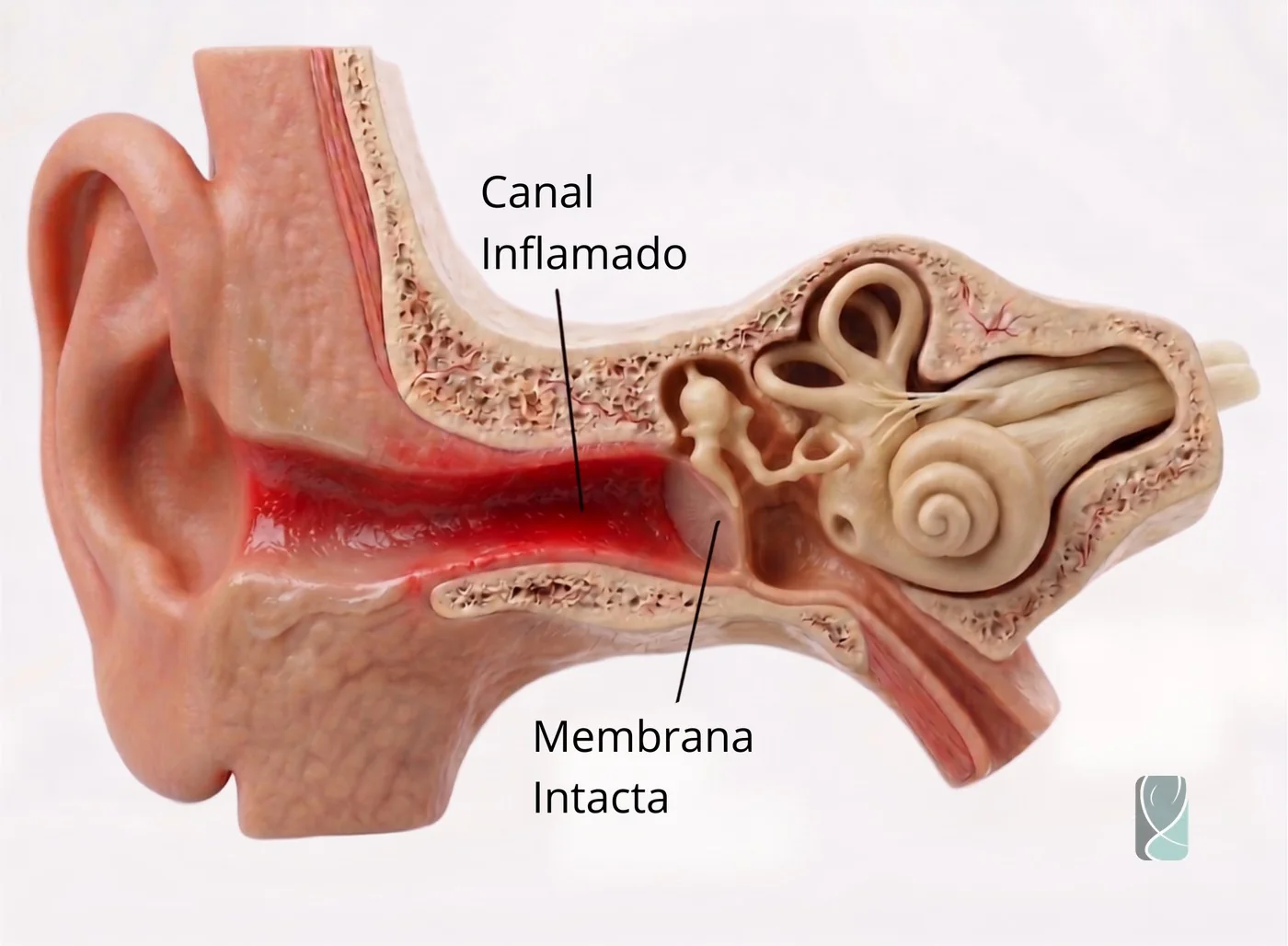Ilustração de otite externa, com o canal auditivo inflamado e a membrana timpânica íntegra