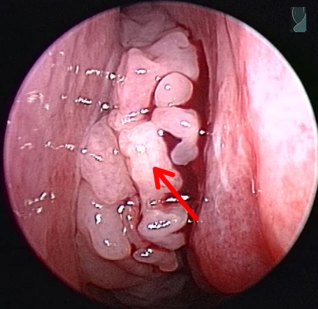 Visão endoscópica do papiloma invertido, com aspecto lobulado e cerebriforme, indicado por seta vermelha
