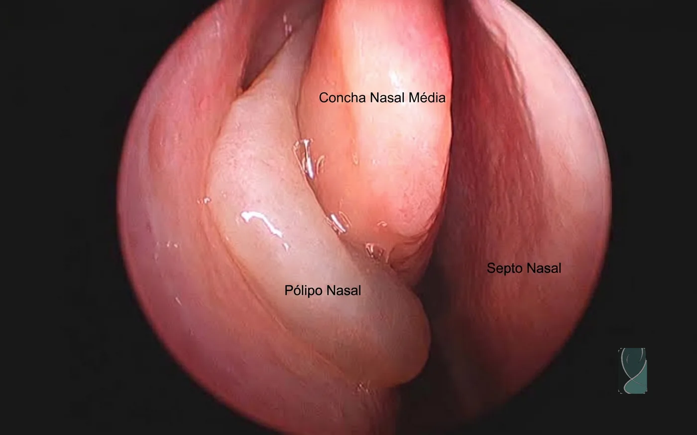 Endoscopia nasal mostrando pólipo nasal entre a concha nasal média e o septo nasal