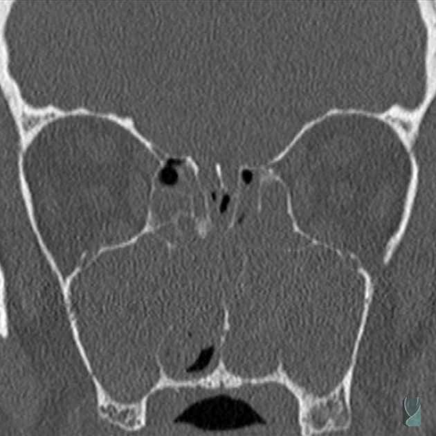 Tomografia computadorizada em corte coronal mostrando os seios da face acometidos pela polipose nasal