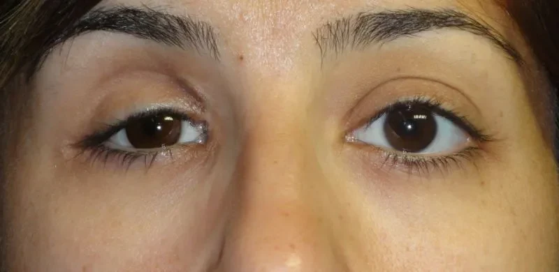 Foto clínica de enoftalmia: olho direito mais fundo e rebaixado na órbita