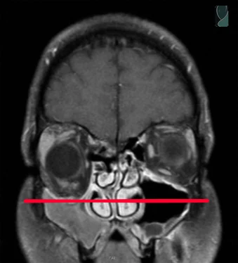 Ressonância magnética evidenciando a assimetria no nível das órbitas na síndrome do seio silente
