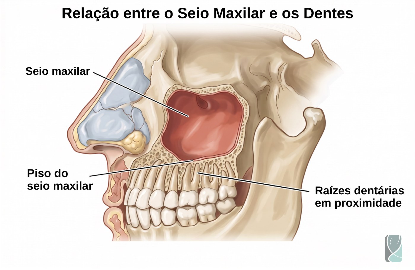 Sinusite Odontogênica (sinusite dentária)