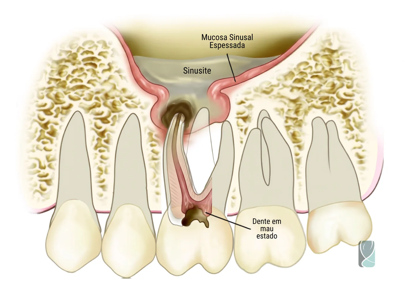 Ilustração de um dente em mau estado gerando sinusite, com espessamento da mucosa do seio maxilar
