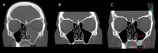 Tomografia antes e depois da cirurgia de sinusite odontogênica, em três cortes (A, B e C)