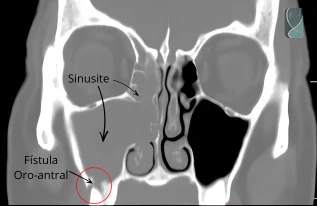 Tomografia computadorizada dos seios da face mostrando sinusite odontogênica e fístula oro-antral