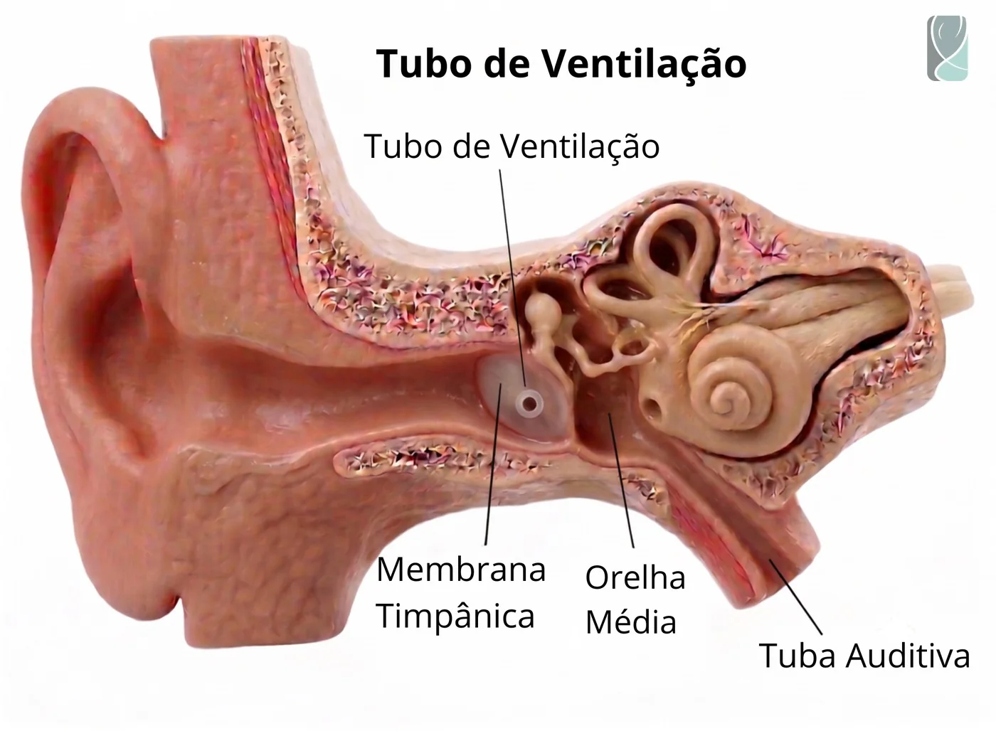 Ilustração do tubo de ventilação colocado na membrana timpânica para tratamento da otite serosa